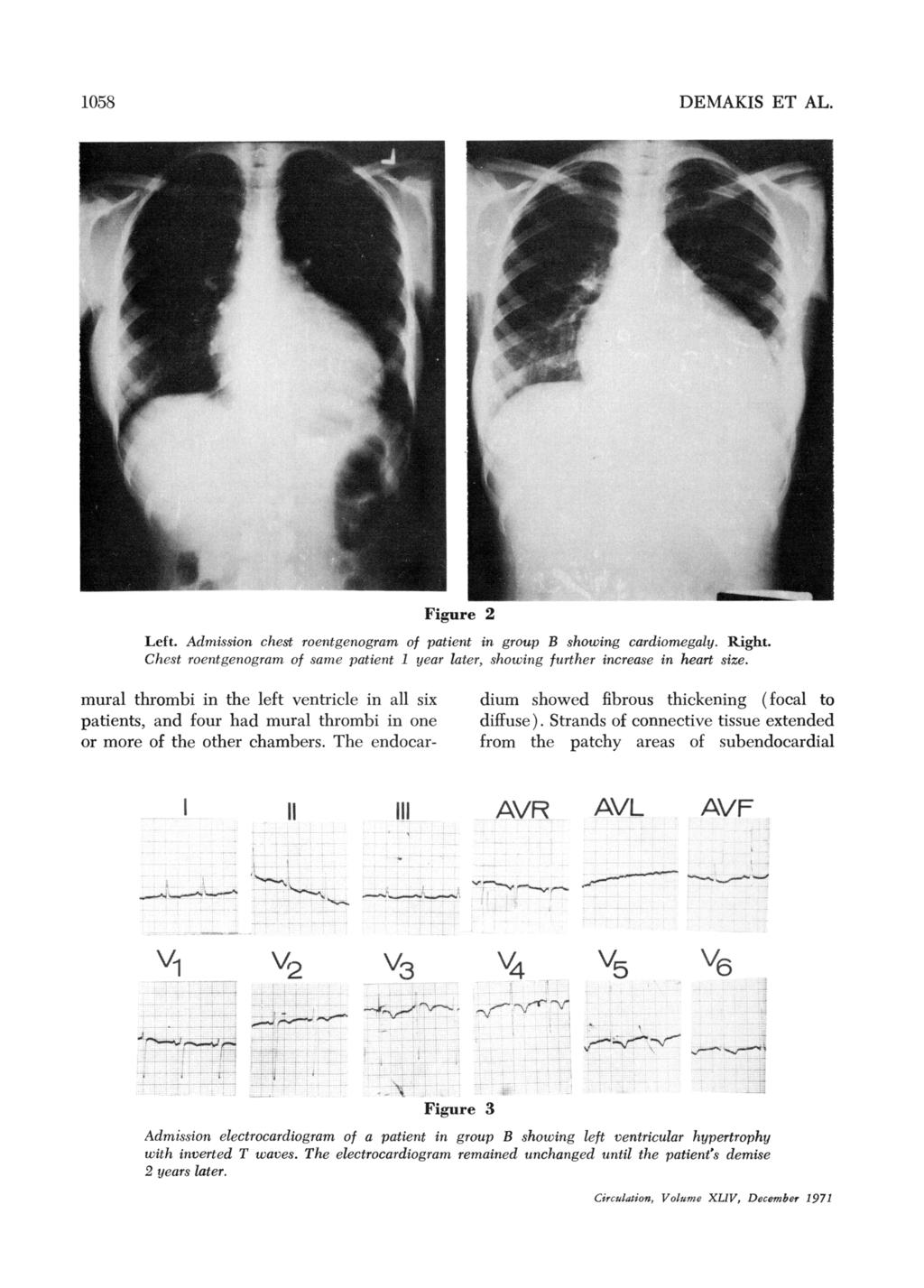 DEMAKIS ET AL. 58. Figure 2 Left. Admission chest roentgenogram of patient in group B showing cardiomegaly. Right.
