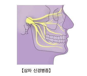 Efficacy of Acupuncture Treatment for Trigeminal Neuralgia DAOM (Doctor of Acupuncture and Oriental medicine) Candidate: David Kim Abstract: A 47-year-old Caucasian female has been suffering from TMJ