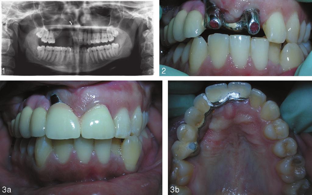 Zygoma Implant-Retained Fixed Partial Denture FIGURES 1 3. FIGURE 1. Panoramic view of the maxillae and mandible pretreatment. FIGURE 2.