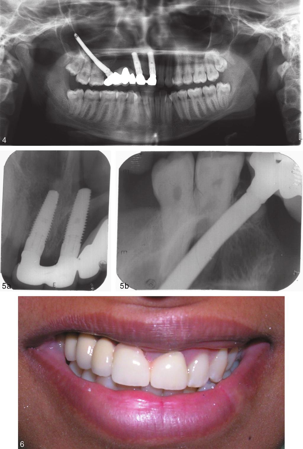 Zygoma Implant-Retained Fixed Partial Denture FIGURES 4 6. FIGURE 4. Panoramic view of the maxillae and mandible (8 months post-treatment). FIGURE 5.