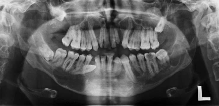 Fig. 1. Panoramic radiograph shows multiple cystic odontogenic lesions in both jaws. Fig. 2. Skull PA radiograph shows falx cerebri calcification.