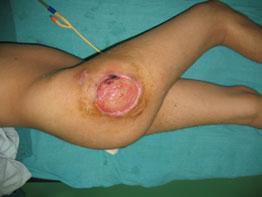 Pressure ulcers can develop when a large amount of