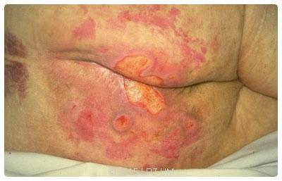 Shear causes much of the damage seen with pressure ulcers.