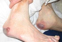bruise, a blister or just an area of