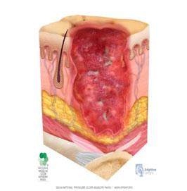 Pressure Injury: Stage 3 full thickness loss of skin adipose (subcutaneous) fat may be visible granulation tissue may be present slough and/or