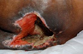 the bridge of the nose, ear, occiput and malleolus do not have subcutaneous tissue, Stage 3 ulcers can be shallow.
