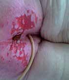 fully eroded, leaving moist or weeping dermis Area may be painful, burning, itching