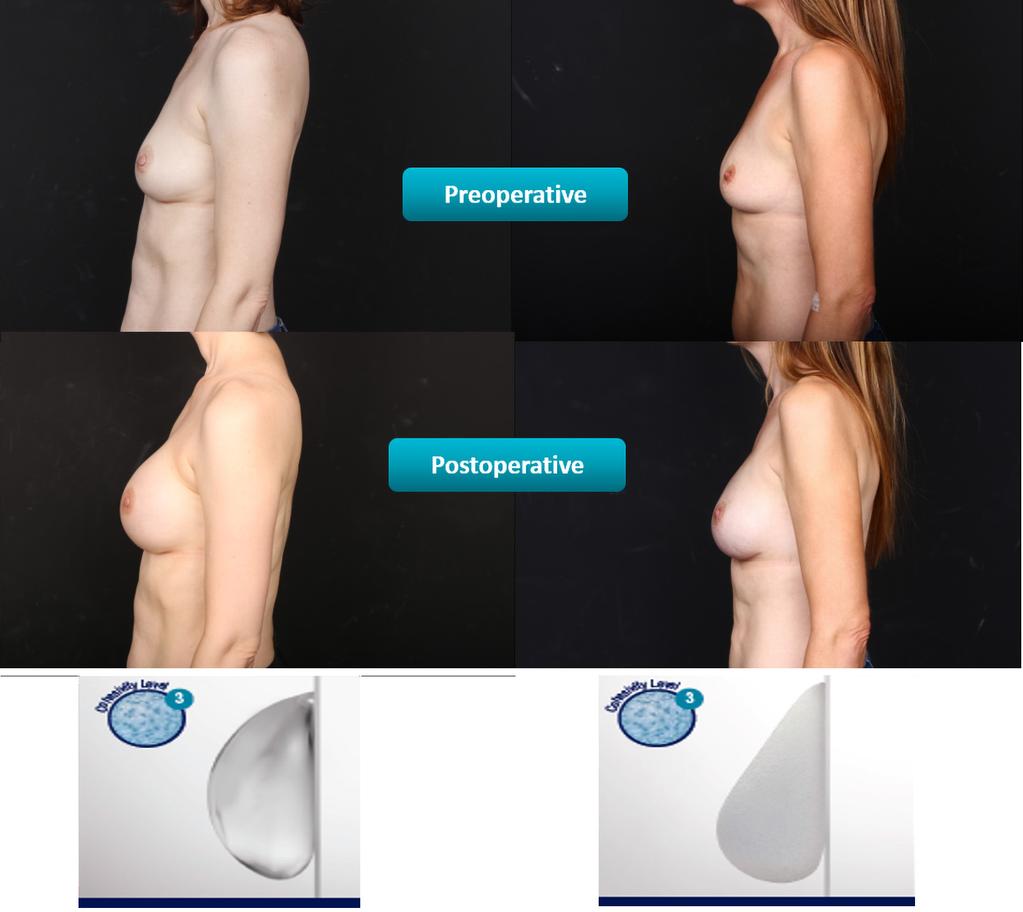 Gland Surgery, Vol 8, No 1 February 2019 41 Figure 6 Breast shape by implant type. Left: breast reconstructed with round, smooth implant; Right: breast reconstructed with anatomic implant.