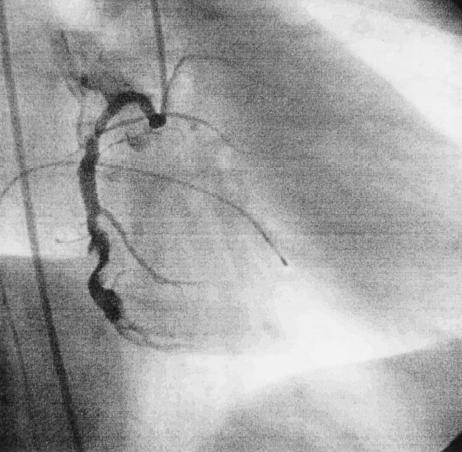 HR and coronary plaque rupture Bradycardia prevents acute