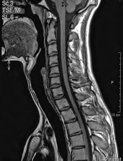 Normal Anatomy and Variants 3 Fig. 1.1. Midline sagittal T1-weighted image of the normal cervical spine obtained with a turbo spin echo (TSE) sequence. Homogeneous appearance of the vertebral marrow.