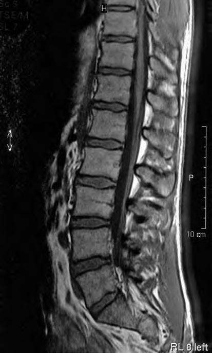 Normal Anatomy and Variants 7 Fig. 1.9. Midline sagittal T1-weighted image of the lumbar spine from T9-10 through S2.