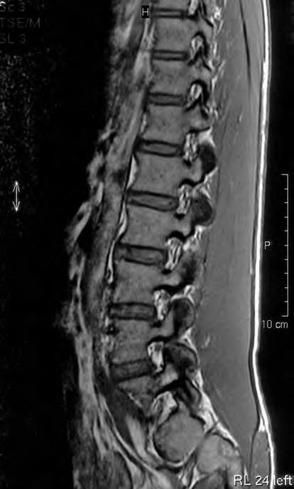 They mostly contain fat in which the spinal nerve roots are discernible as low-signal-intensity punctate structures, typically located in the upper third.