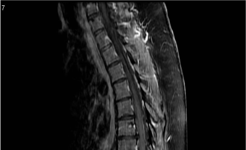 DIAGNOSIS X ray posterior scalloping of vertebral body