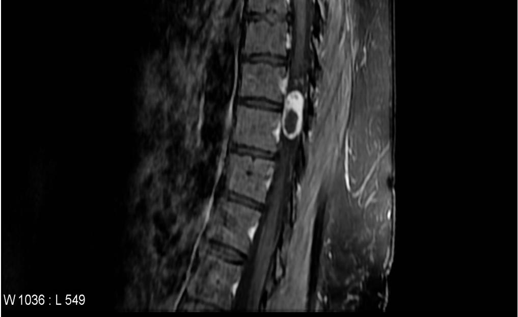 intraspinal mass MRI T1-Hyperintense compared to muscle