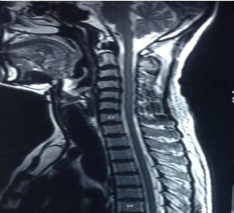 ANATOMY SPINAL CORD EXTENDS FROM MEDULLA OBLONGATA TO L1 / L2 IN ADULTS, NEW BORN L3/L4.