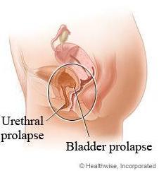 Urethrocele Image source: http://64.143.176.