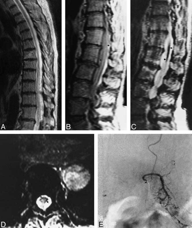 AJNR: 21, April 2000 VENOUS HYPERTENSIVE MYELOPATHY 785 FIG 5. A, Sagittal FSE T2-weighted (5417/98) MR image shows increased central cord signal with subtle peripheral hypointensity.