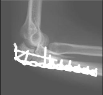 Don t throw away proximal bone Comminuted proximal ulnar fragments