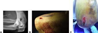 Incorporate open wound with incision or ignore?