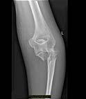 Question Ulnar fracture fixation 1 Tension band wires/
