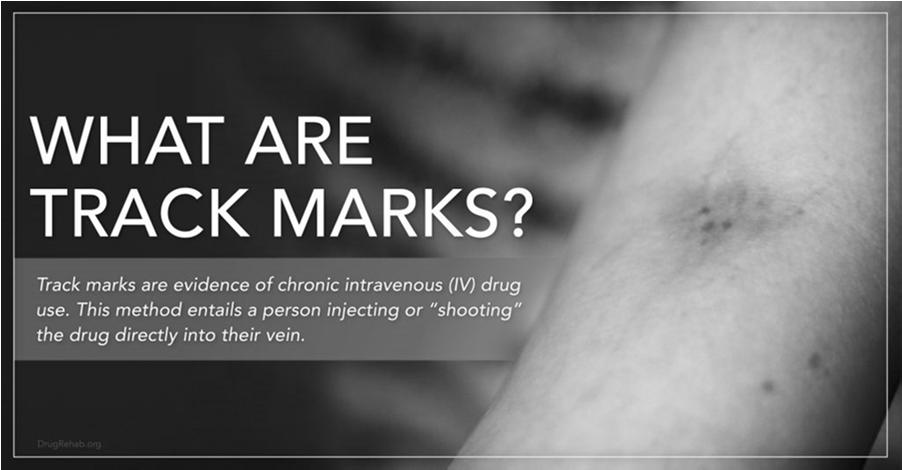 Recognizing signs of IV drug use Track marks Hand, foot, leg, neck Long sleeves on hot days Do good physical exam Look for soft