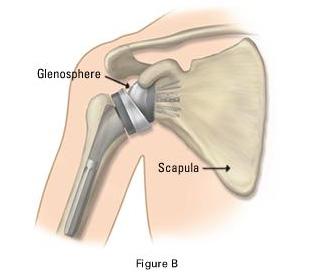 It changes the orientation of the shoulder such that the normal socket (glenoid) is replaced with an artificial ball, and the normal ball (humeral head) is replaced with an implant that has a socket
