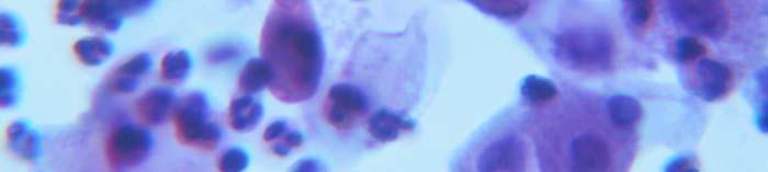 Small, rounded, this basophilic parabasal squamous cells is typical of Atrophic cells.