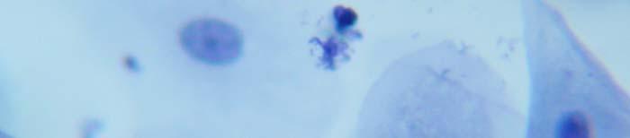 SQUAMOUS CELL ABNORMALITIES 141-ASCUS: 40x magnification of atypical squamous cells (of undetermined