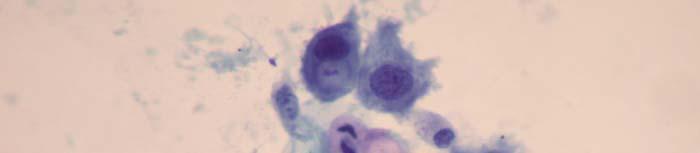SQUAMOUS CELL ABNORMALITIES 144-ASCUS: 40x magnification atypical squamous cells (of undetermined