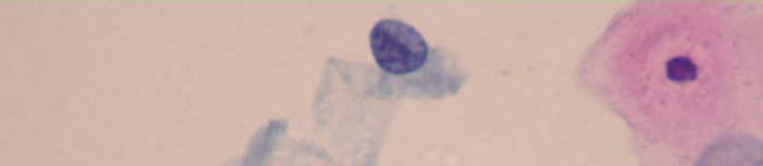 SQUAMOUS CELL ABNORMALITIES 173-HSIL : 40x magnification of cells in loosely
