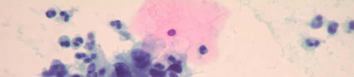 SQUAMOUS CELL ABNORMALITIES 180-HSIL: 40x magnification of cells in