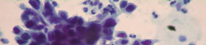 SQUAMOUS CELL ABNORMALITIES 182-HSIL: 40x magnification of cells in