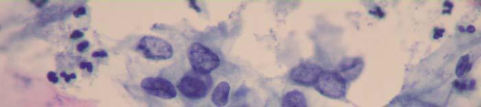 SQUAMOUS CELL ABNORMALITIES 188-HSIL: 40x magnification cells in loosely cohesive groups, parabasal, metaplastic or basal type.
