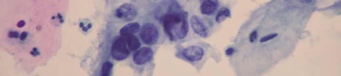 The nuclei are enlarged and hyperchromatic, high N/C ratio. The chromatin is fine to coarsely clumped.