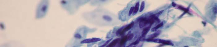 SQUAMOUS CELL ABNORMALITIES 200-Squamous Cell Carcinoma: 40x magnification of cells isolated,