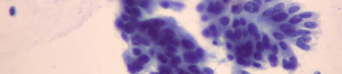 glandular like (nuclei acinar pattern, branching, glandular like (nuclei around the opening with