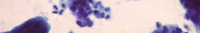 coarsely granular. Micronucleoli are present.