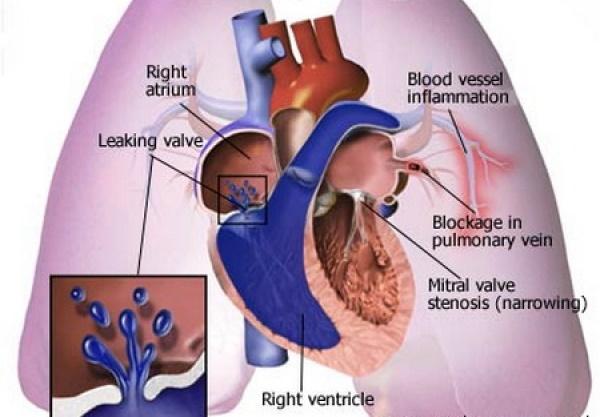 First Indication: Pulmonary Hypertension (PH) Overview NO is an established therapeutic option for patients suffering from Pulmonary Hypertension worldwide Pulmonary Hypertension Overview Effects of