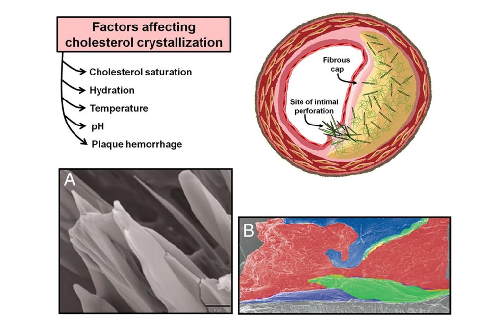Effects of cholesterol crystals on plaque integrity in coronary arteries of