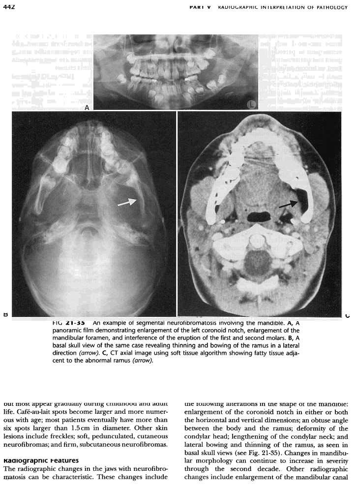 442 PARI V KAUIUI.,KAI'HIL IN I I:.K I' KI:. ration OF PATHOLOGY tj \.; I-llJ Zl-.:S~ An example Of segmental neurofibromatosis Involving the mandible.