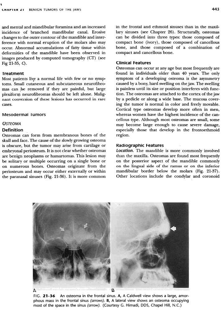 , CHAPTtK ~.. BENIGN TUMORS OF THE JAWS 443 ~d mental and m'andibular foramina and an increased ihcidence of branched mandibular canal.