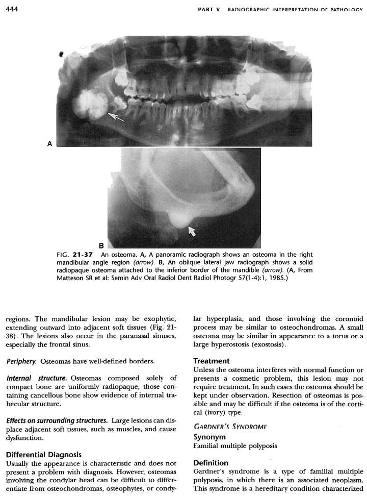 ~ 444 PART V RADjOGRAPHIC INTERPRETATION OF PATHOLOGY, A B --, FIG. 21-37 An osteoma. A, A panoramic radiograph shows an osteoma in the right mandibular angle region (arrow).