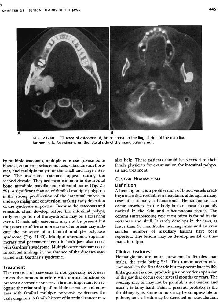 , CHAPTER 21 BENIGN TUMORS OF THE JAWS 445 B FIG. 21-38 CT scans of osteomas. A, An osteoma on the lingual side of the mandibular ramus. B, An osteoma on the lateral side of the mandibular ramus.