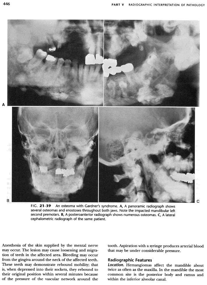 446 PART V RAD10GRAPHIC INTERPRETATION OF PATHOLOGY A FIG. 21-39 An osteoma with Gardner's syndrome. A, A panoramic radiograph shows several osteomas and enostoses throughout both jaws.