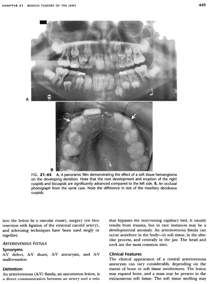 CHAPTER 21 BENIGN TUMORS OF THE JAWS 449 A B FIG. 21-45 A, A panoramic film demonstrating the effect of a soft tissue hemangioma on the developing dentition.