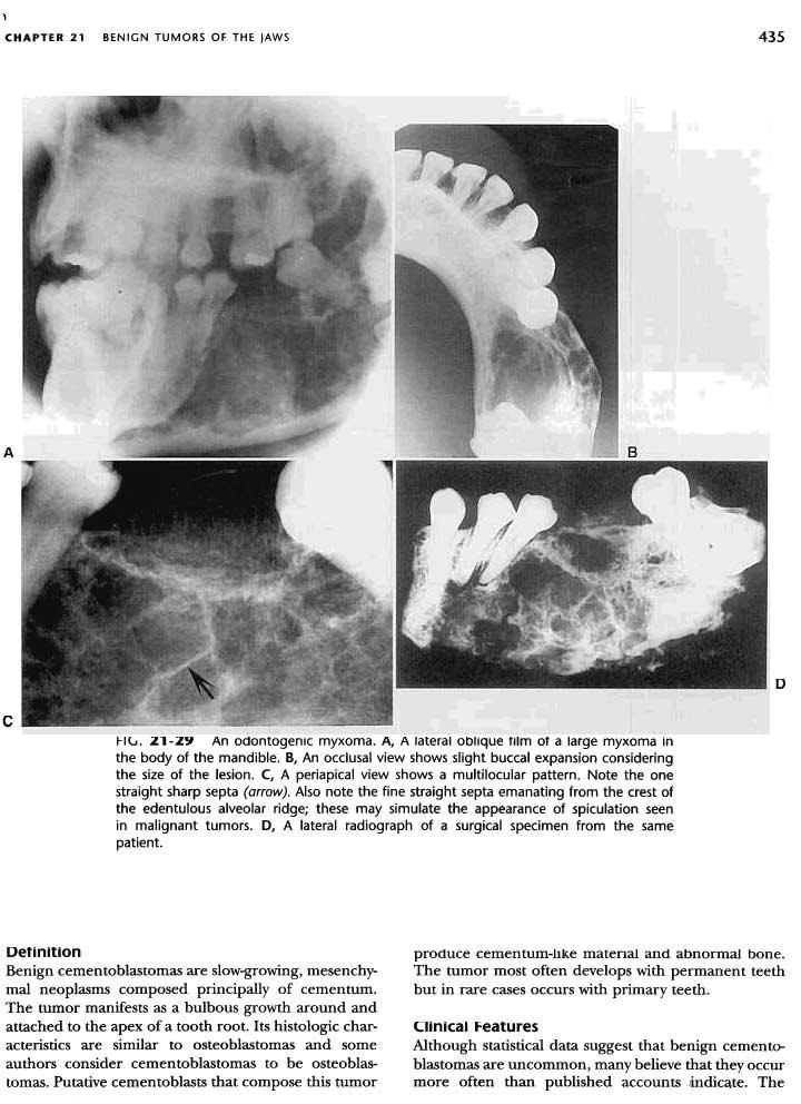 'I CHAPTER 21 BENIGN TUMORS OF THE JAWS 435 A D c I-ill. 21-2Y An odontogenic myxoma. A, A lateral oblique tllm ot a large myxoma in the body of the mandible.