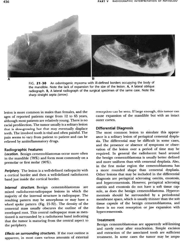 436 PART V RADIOGRAPHIC INTERPRETATION OF PATHOlOG' A B FIG. 21-30 An odontogenic myxoma with ill-defined borders occupying the body of the mandible.