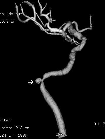 342 Hirofumi Oyama et al. occlude it temporarily. Subsequently, an internal carotid artery was trapped and the vein graft was recanalized by opening its distal clip.