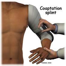 Upper Extremity Splints Coaptation Humerus Shaft Fx Elbow at 90 Splint up to neck