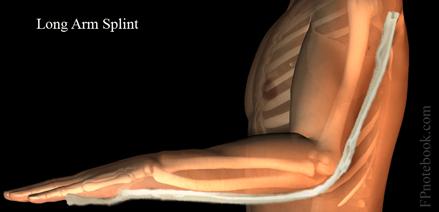 com/media gallery/detail/32/86 Upper Extremity Splints Long Arm Distal Humerus Fx